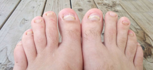Nail fungus of the feet