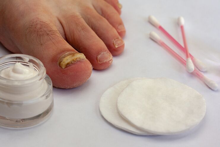foot fungus treatment with mushroom cream