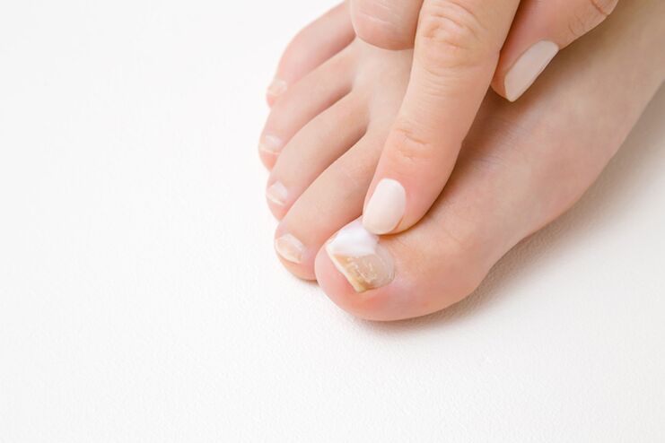 treatment of toes with fungus ointment