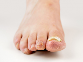 mycosis of the feet