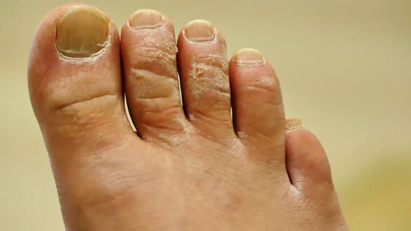 scaly toenail fungus