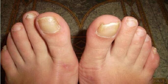 what toenail fungus looks like