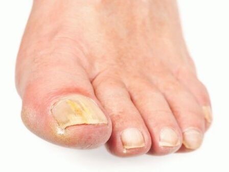 nail damage with fungus on the feet