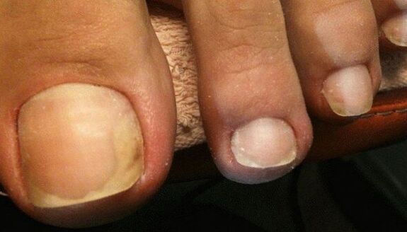 Signs of the early stage of toenail fungus