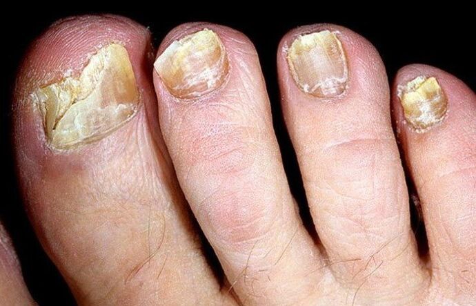 fungus on the toenails