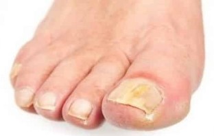 The first step of the fungal infection of the toenail