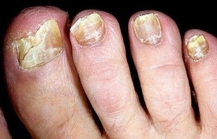The nails crumble yeast infections