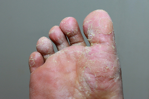 Heavy on the stage of the fungal infection of the skin of the toes